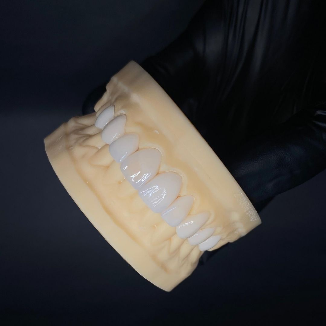 Carillas en cerámica (disilicato) - Disilicato de litio - servidident