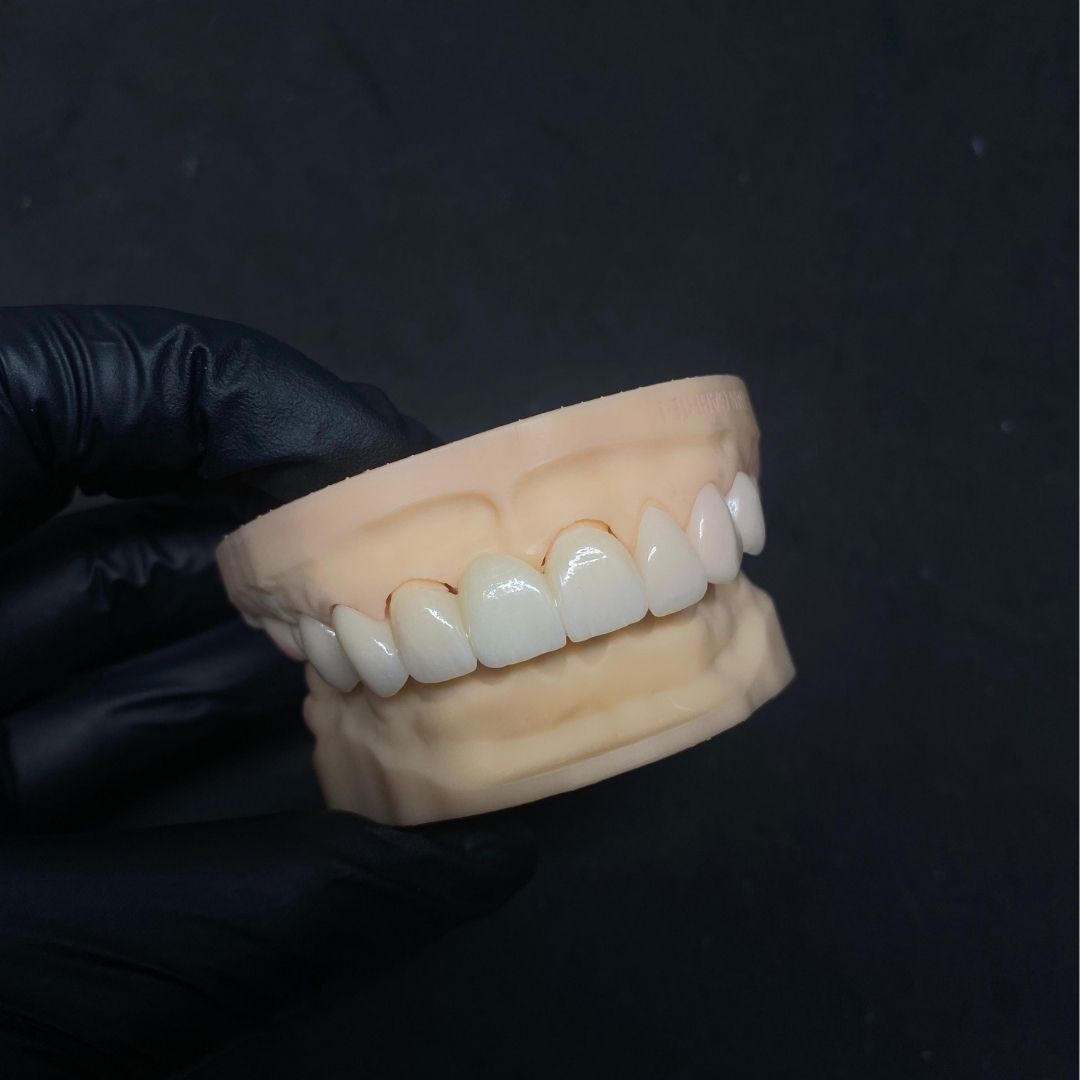 Corona en disilicato de litio (LT / HT) - Disilicato de litio - servidident