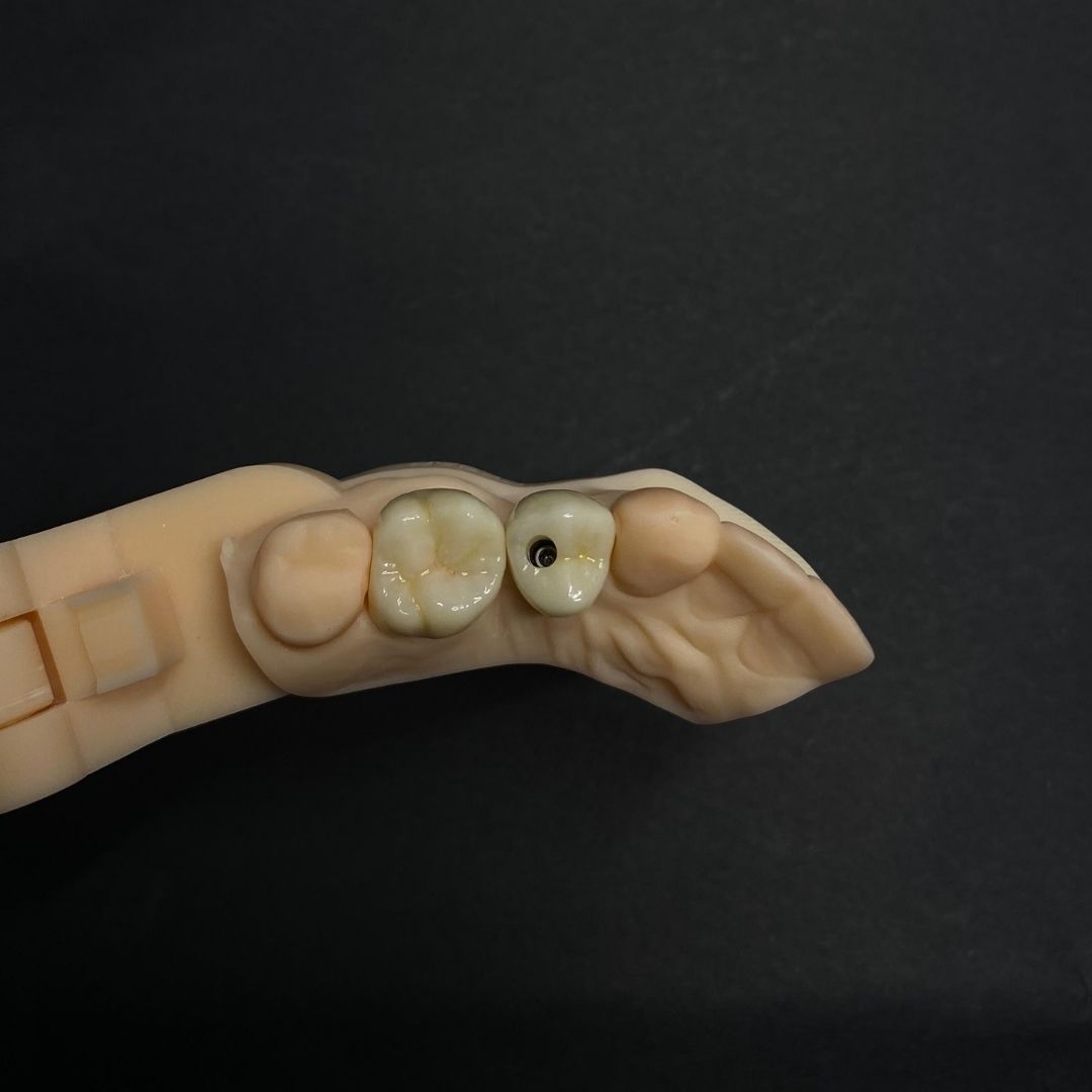 Corona sobre implante en zirconio - Zirconio - servidident