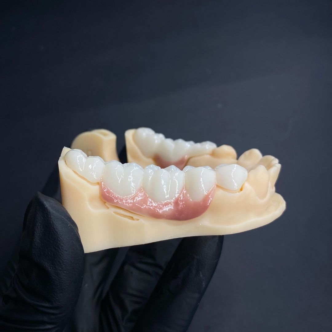 Corona en zirconio monolítico - Zirconio - servidident