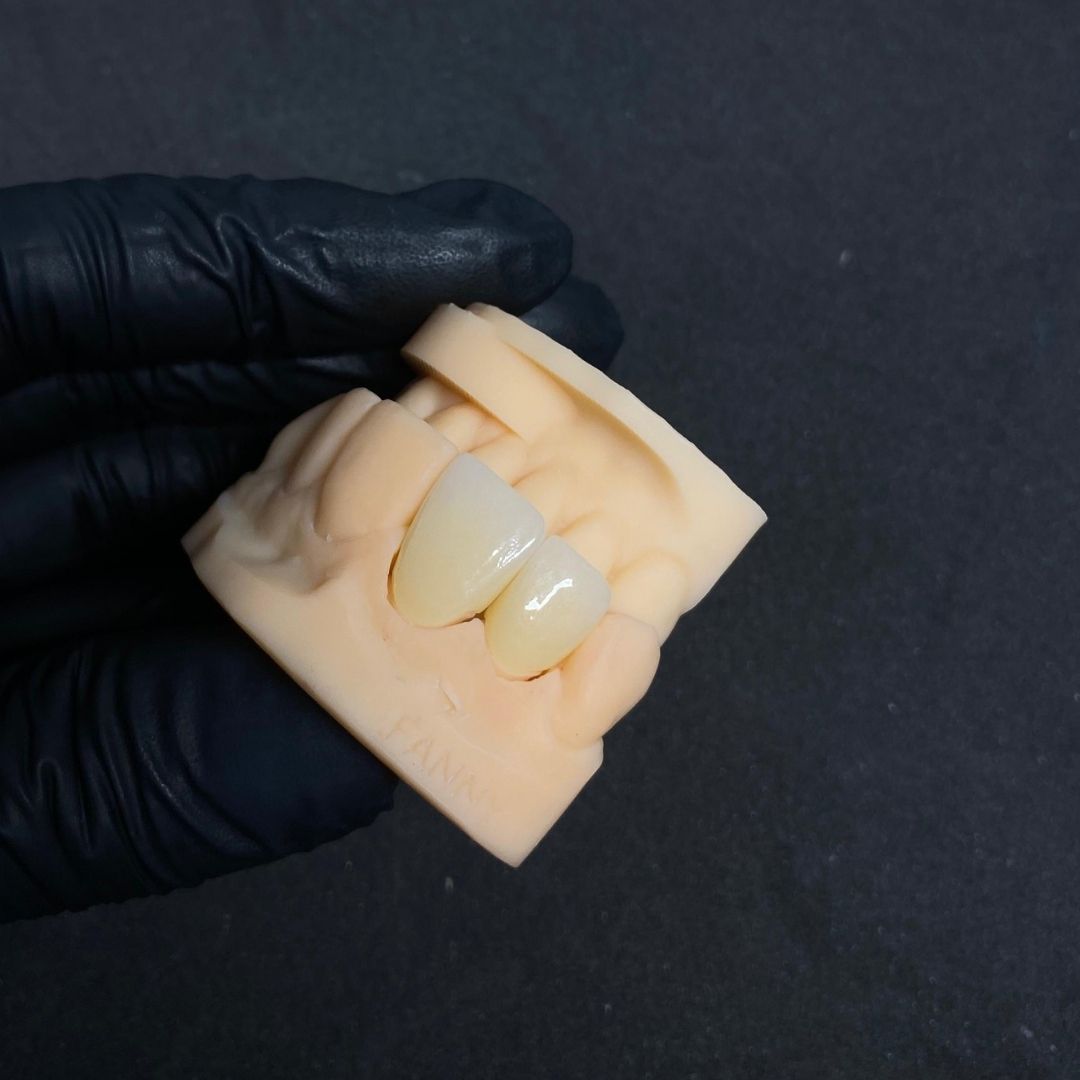 Corona en zirconio multilayer - Zirconio - servidident